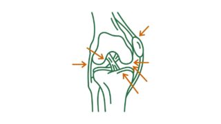 dolor en la rodilla